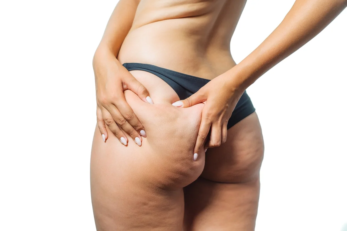 Foto colorida de mulher apertando o bumbum e mostrando a celulite - Metrópoles